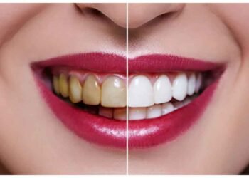 ‘દાંત કહે છે મને સુનાર પાસે વેચી દો, દાંત મોતી જેવા ચમકવા લાગશે, સૂતા પહેલા કરવાનું છે આ કામ,