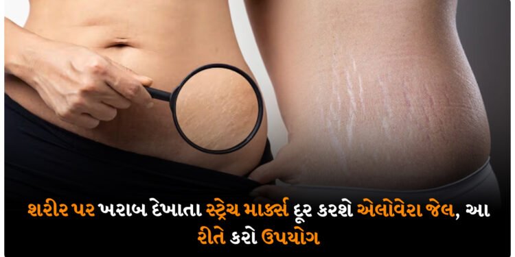 શરીર પર ખરાબ દેખાતા સ્ટ્રેચ માર્ક્સ દૂર કરશે એલોવેરા જેલ, આ રીતે કરો ઉપયોગ